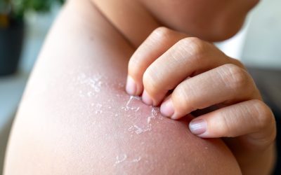 Tombol a nyár! Hogyan óvhatjuk gyermekeink bőrét?